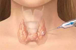 Размер узла щитовидной железы не снижает информативность тонкоигольной аспирационной биопсии